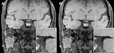 Como melhorar a detecção de lesões na ressonância magnética de parede vascular? Como melhorar a detecção de lesões na ressonância magnética de parede vascular?